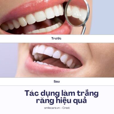 Miếng dán trắng răng crest